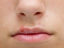 Herpes Labial