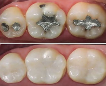 Qual o melhor material para restaurar um dente ? Reportagem na revista Veja Ciência, analisa esse assunto